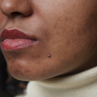black skin hyperpigmentation - scars - dado cosmetics