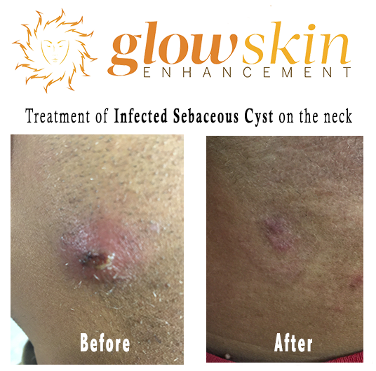 sebaceous cyst back