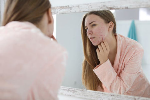 acne skincare