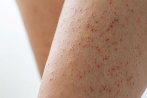 red bumps on skin