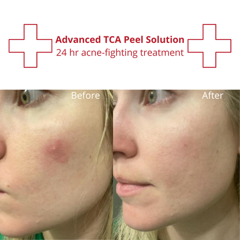 TCA Advanced Peel Solution before and after