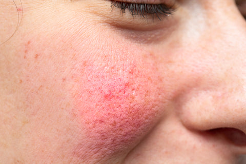 What is Rosacea