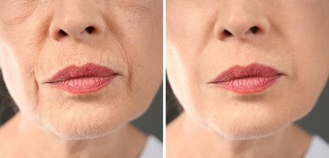 wrinkles on top of lip before and after