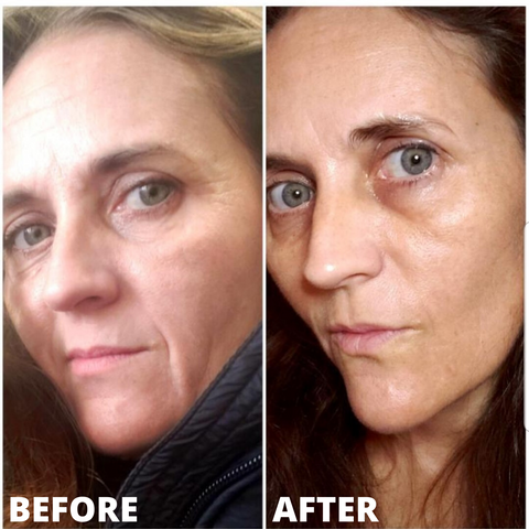 Glycolic Peel Cleansing before and after woman