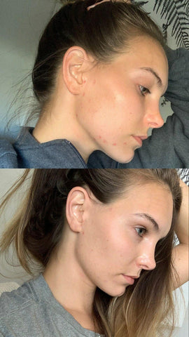 acne before and after