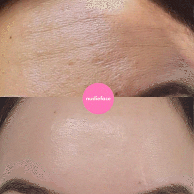 Notox Silicone Wrinkle Patch Results