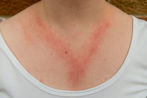 photo of a woman with skin irritation from the nickel in a necklace
