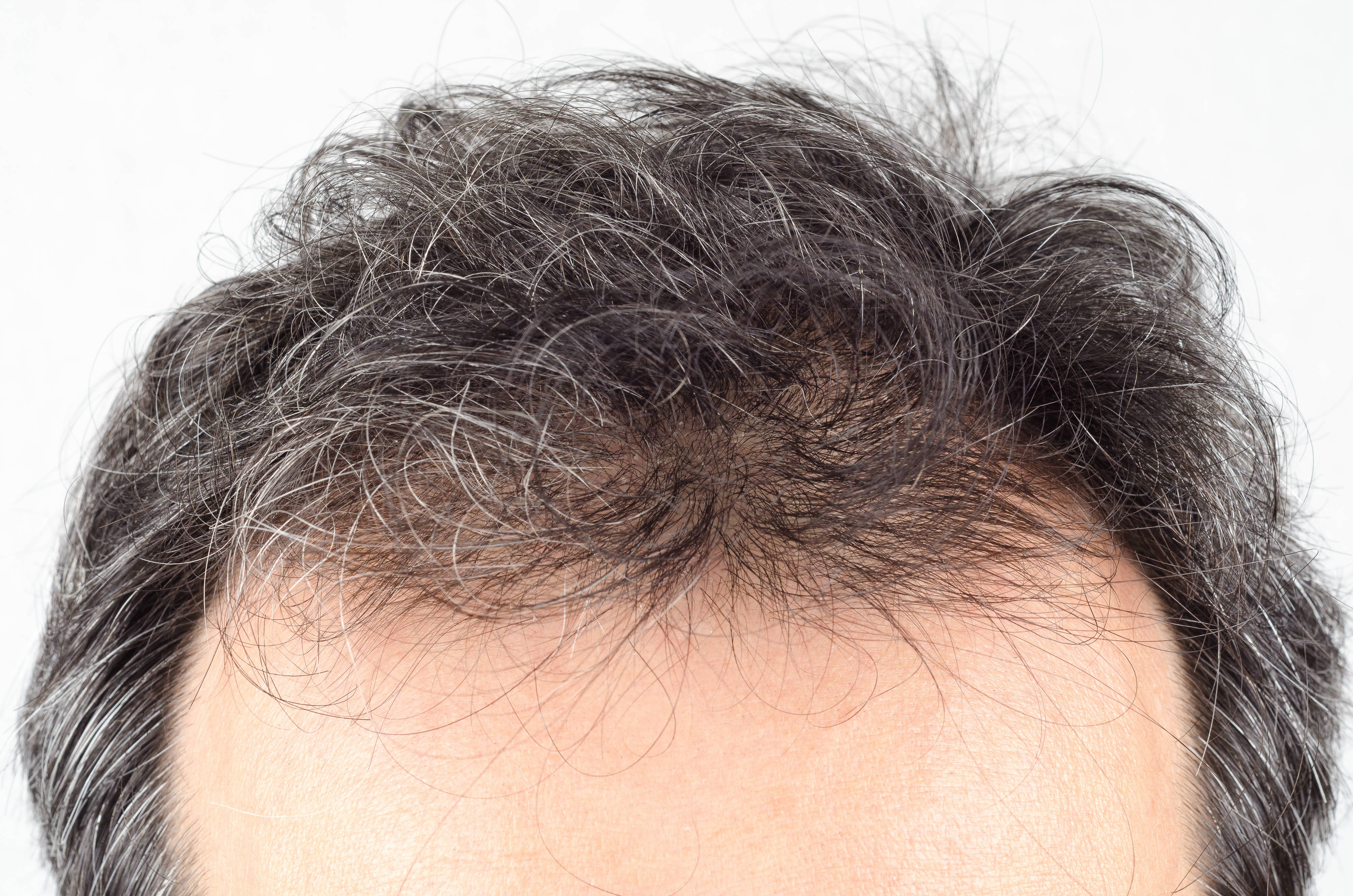 5 Causes Of Hair Loss You May Not Be Aware Of Professor Hair