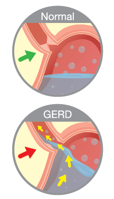 Refluxerkrankung GERD - Rückfluss aus der Speiseröhre