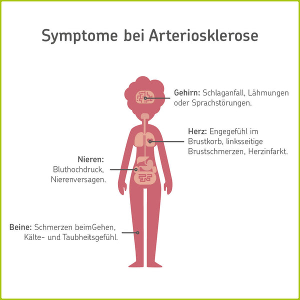 Infografik: Arteriokslerose-Symptome in Gehirn, Herz, Nieren und Beinen