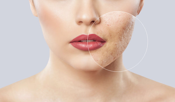 Frau mit Hautunreinheiten im Gesicht