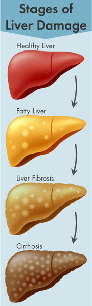 infographic showing the stages of Liver Damage: Healthy Liver to Fatty Liver to Liver Fibrosis to Cirrhosis