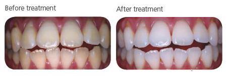 Tooth Whitening Pola Office AL FAYROUZ MEDICAL EQUIPMENTS TRADING