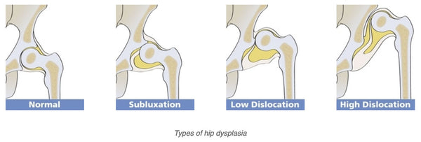 Types of Hip Dysplasia in Infants (photo credit: Hip Dysplasia Institute)