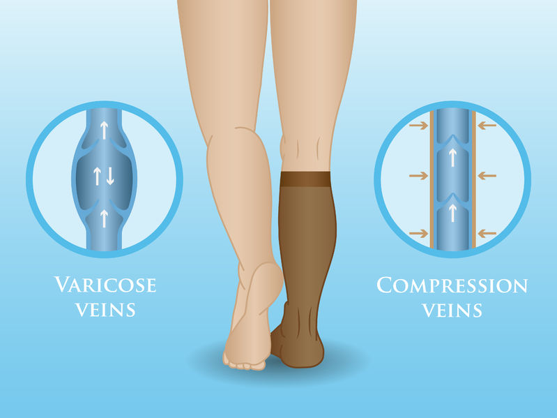 How Do Compression Socks Work?