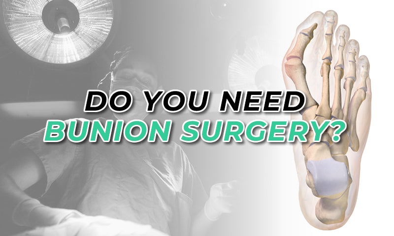 Should You Undergo Surgery For a Bunion?