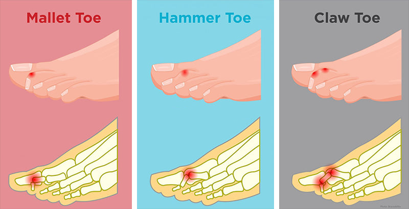 Differences between a hammer toe, claw toe and mallet toe