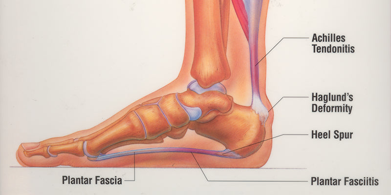 Heel Pain - Southern Sports Podiatry - Queenstown & Invercargill