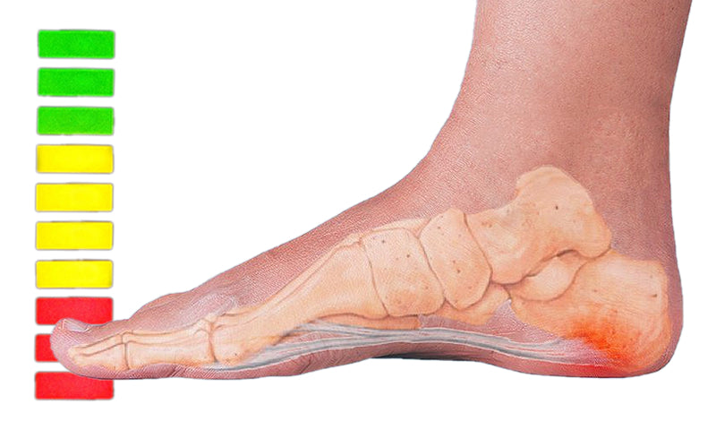 Heel Fat Pad Syndrome: Symptoms, Causes & Treatment