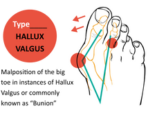 Hallux valgus bunion diagram malposition of the big toe 