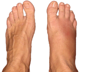 swellnomore-edema-feet-remedy