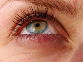eczema dark circles under eyes cause