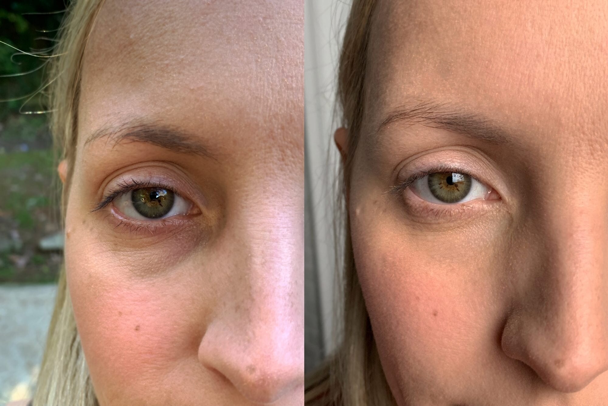 Before using. Темные круги под глазами Эстетика. Dark circles under the Eyes. Крем вокруг глаз under Eye Lightening. Dark circle under Eye Filler before and after.