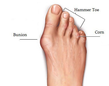 Bunions, Hammer Toes and Foot 