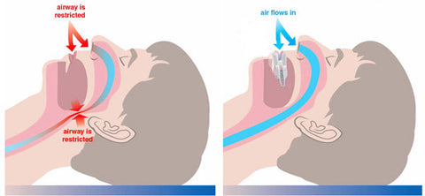 stop snoring mouthpiece
