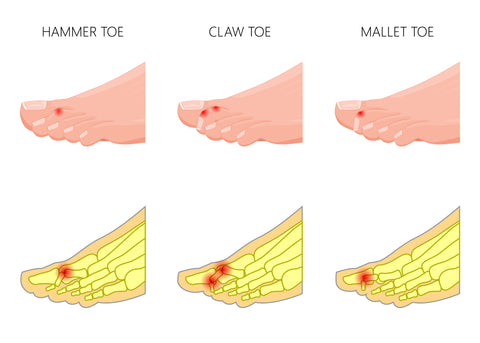 three types of hammer toe: hammer toe, claw toe, mallet toe