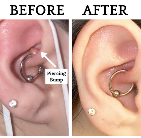 piercing bump keloid scar treatment solution how to 