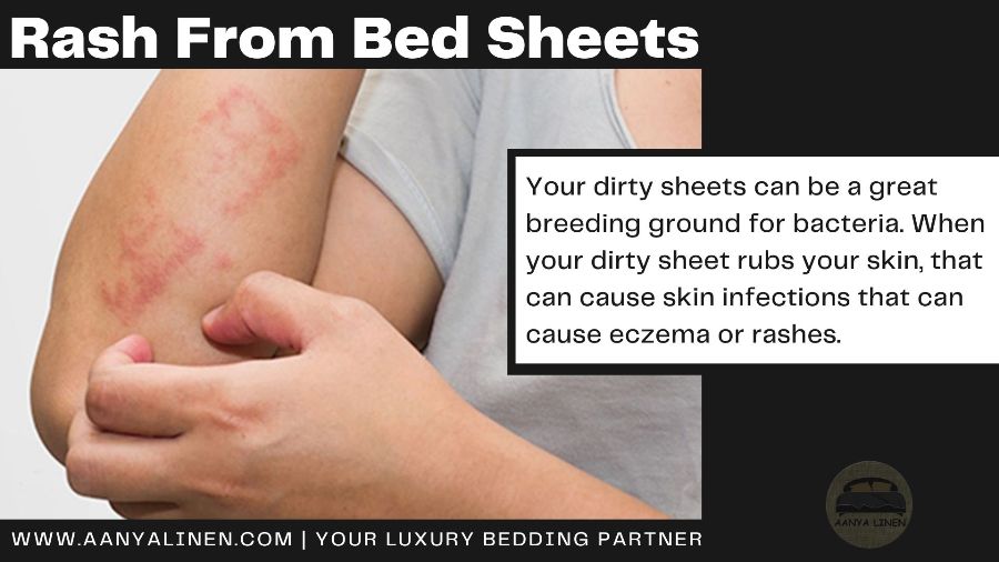 Rash from bed sheets