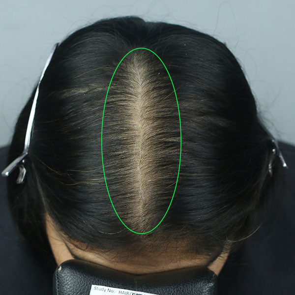 After 12 weeks reduced hair thinning