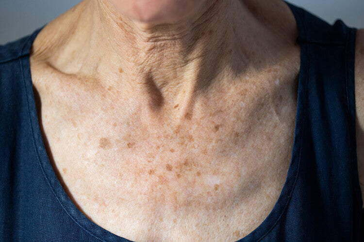 Age spots on a lady's chest