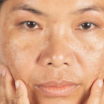 Facial Dark spots