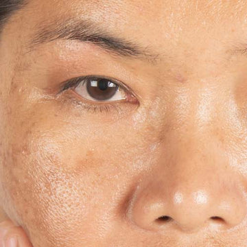 Dark spots on face