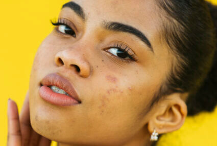 Acne which further leaves behind scars