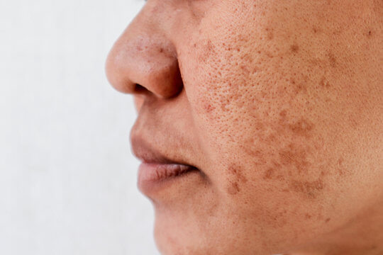 Melasma