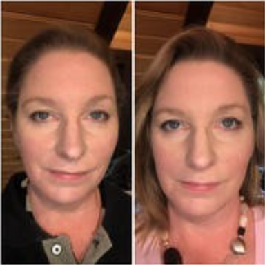 Before/After picture of a woman's face 10 mobile