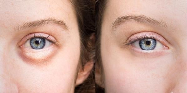 What Causes Puffiness Under the Eyes? - VIDA Wellness and Beauty