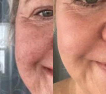 Before/After close-up picture of woman's face 1 mobile