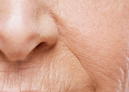 Upper lip wrinkles