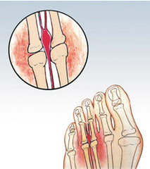 new balance for morton's neuroma