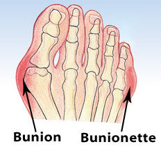 bunionette