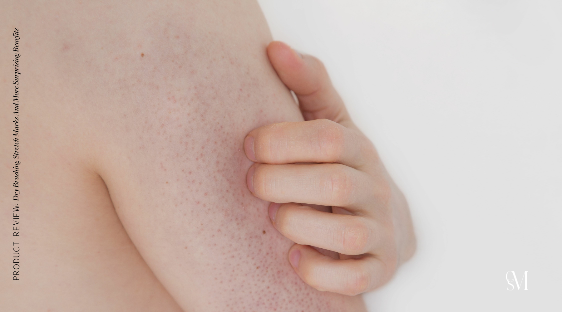 Keratosis Pilaris or commonly called Chicken Skin is a protein build-up called Keratin in the pores.
