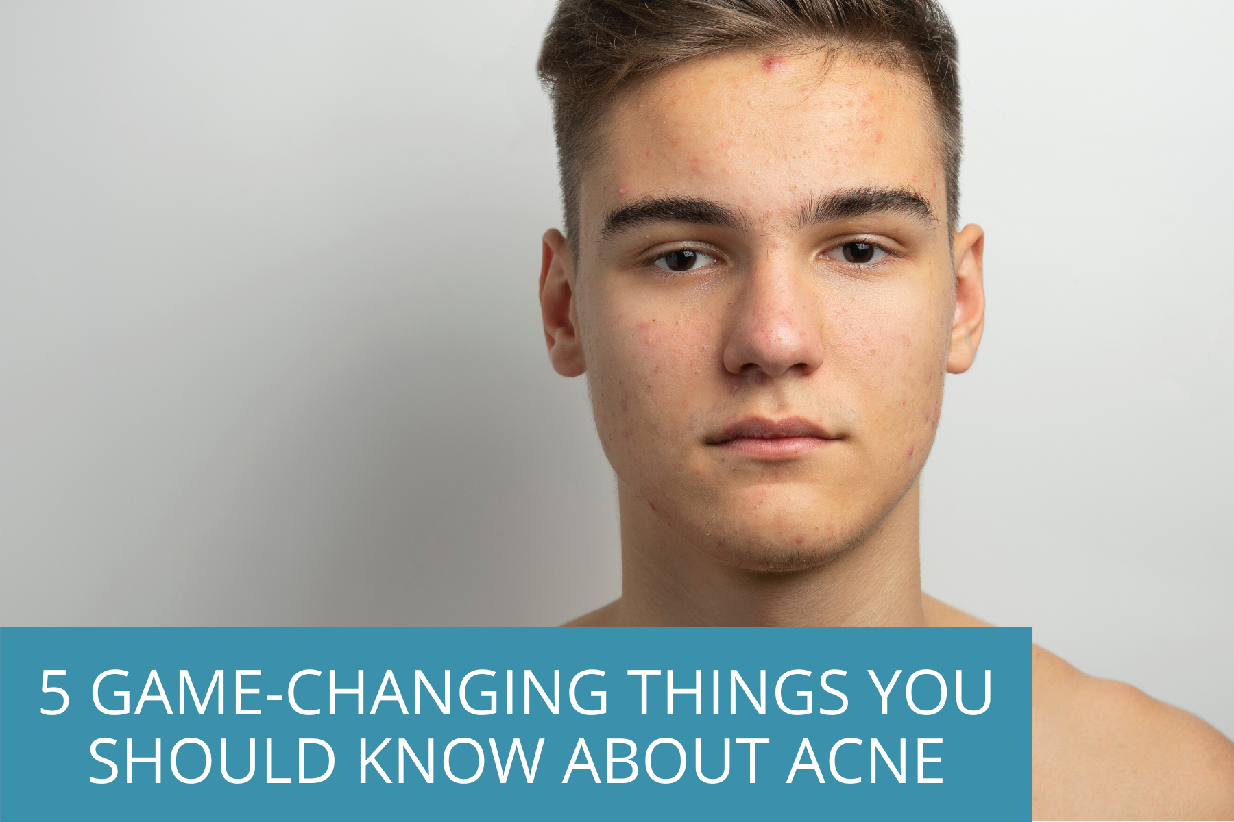 Teenager with facial acne. | 5 Things You Should Know About Acne | TEENOLOGY