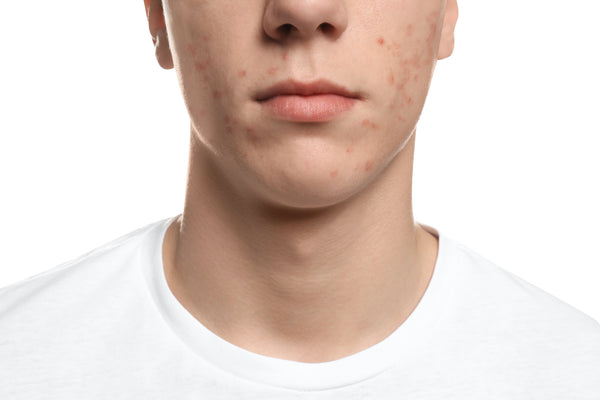 Teen boy with maskne and pomade acne. 