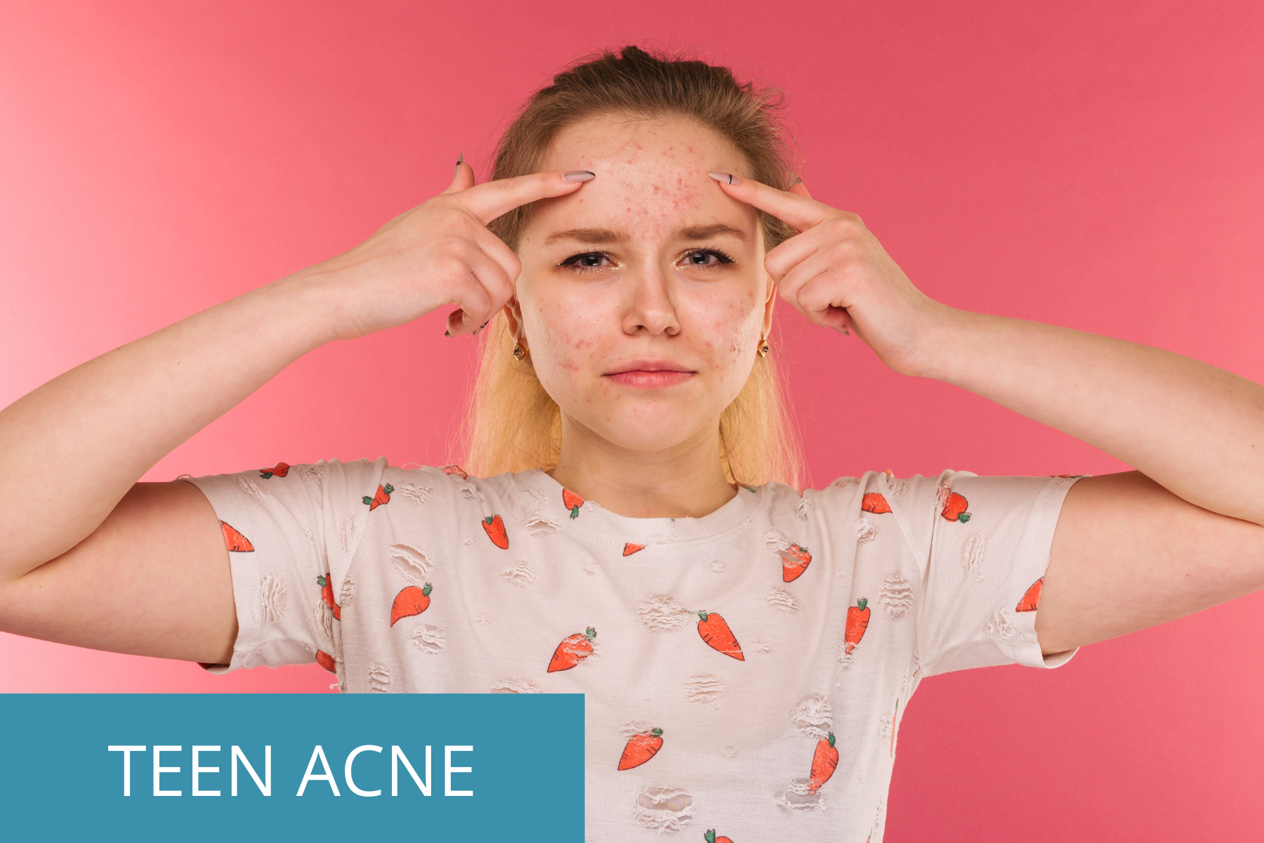 teen girl touching her acne