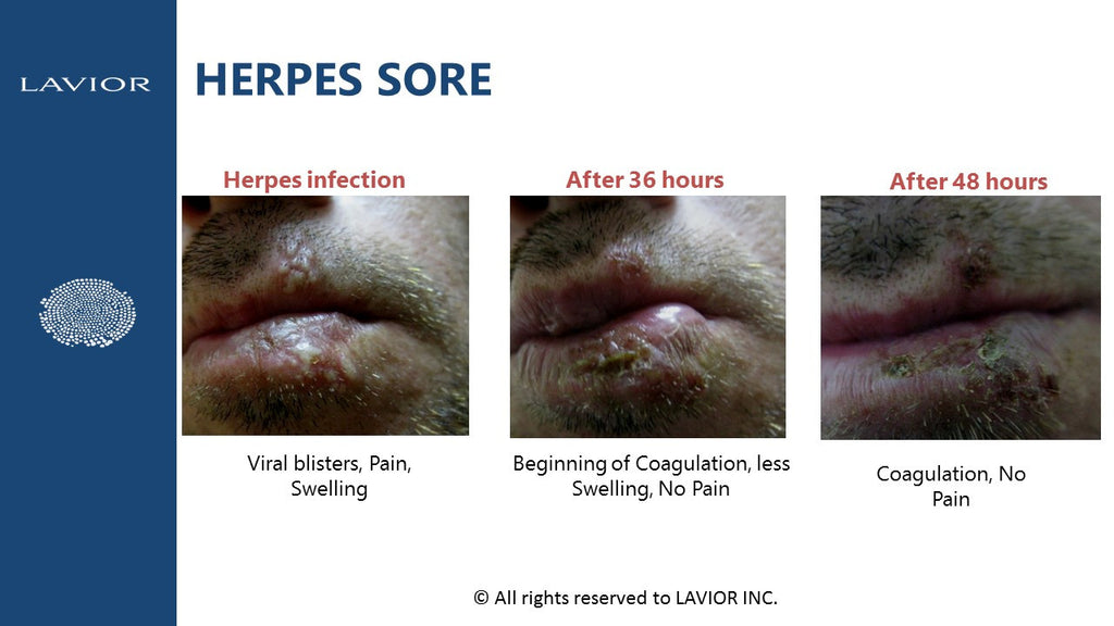 current research on herpes