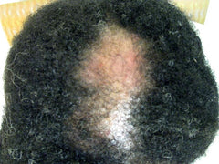 Scalp suffering from Central centrifugal cicatricial alopecia (CCCA)